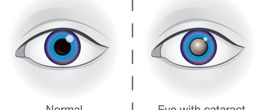 Diabetes and Eyes - Diabetic Cataract